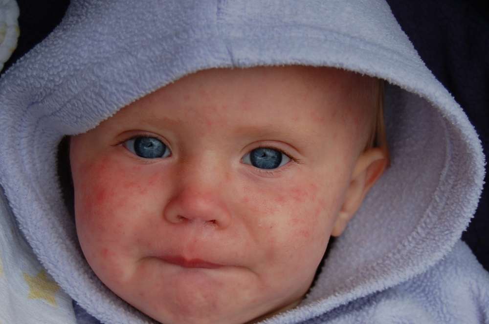 14 cases of measles in Cyprus in 2018; EU cases surge as pockets refuse vaccination